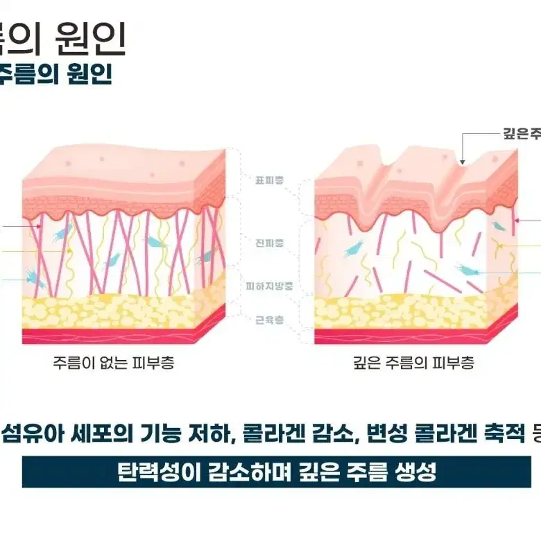 새상품 / 전문가용 하이프 / 셀룰라이트 제거/ 리프팅 관리