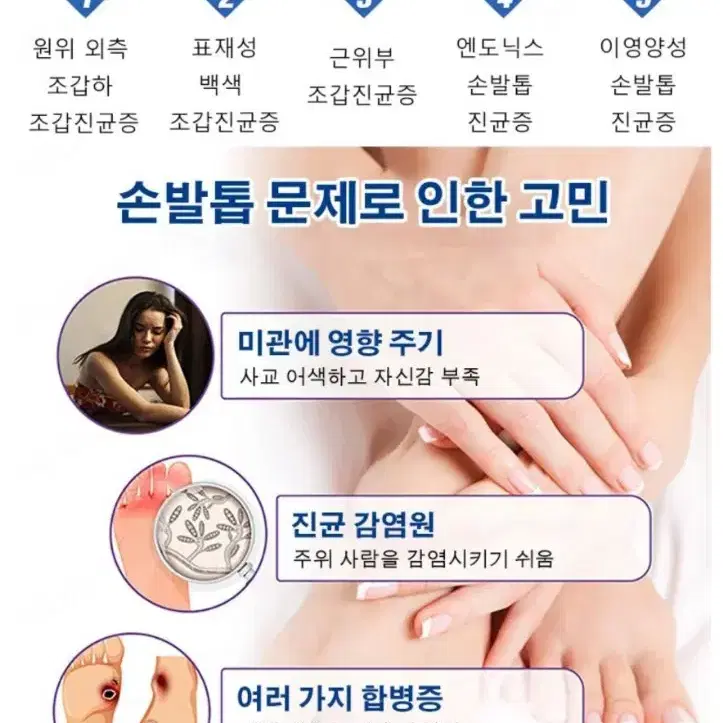 진균레이저, 발톱무좀