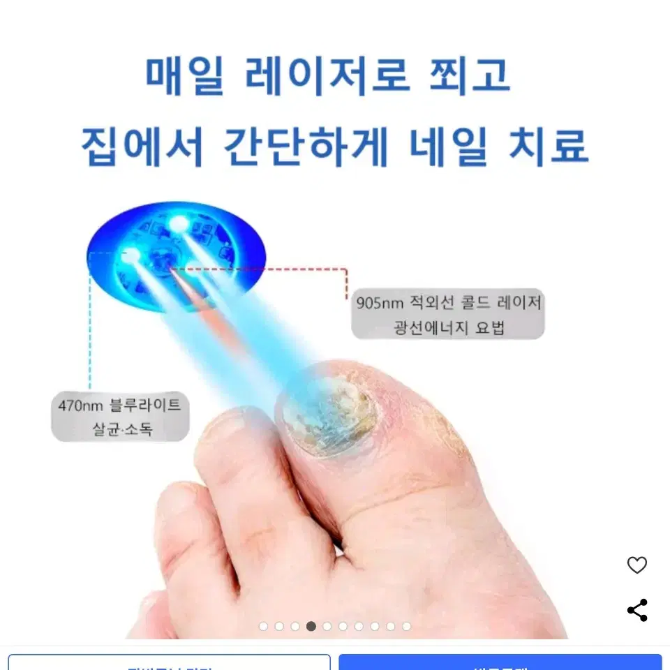 진균레이저, 발톱무좀