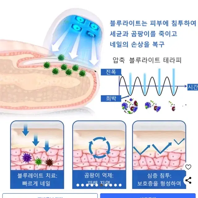 진균레이저, 발톱무좀