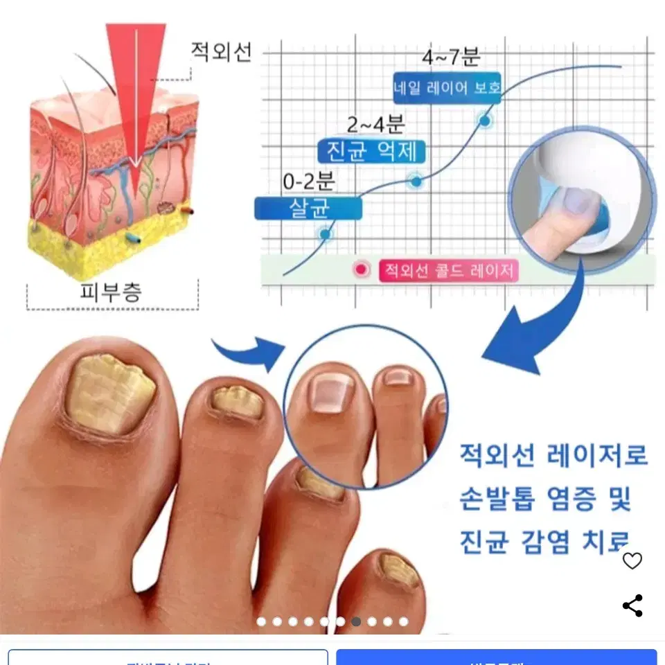 진균레이저, 발톱무좀