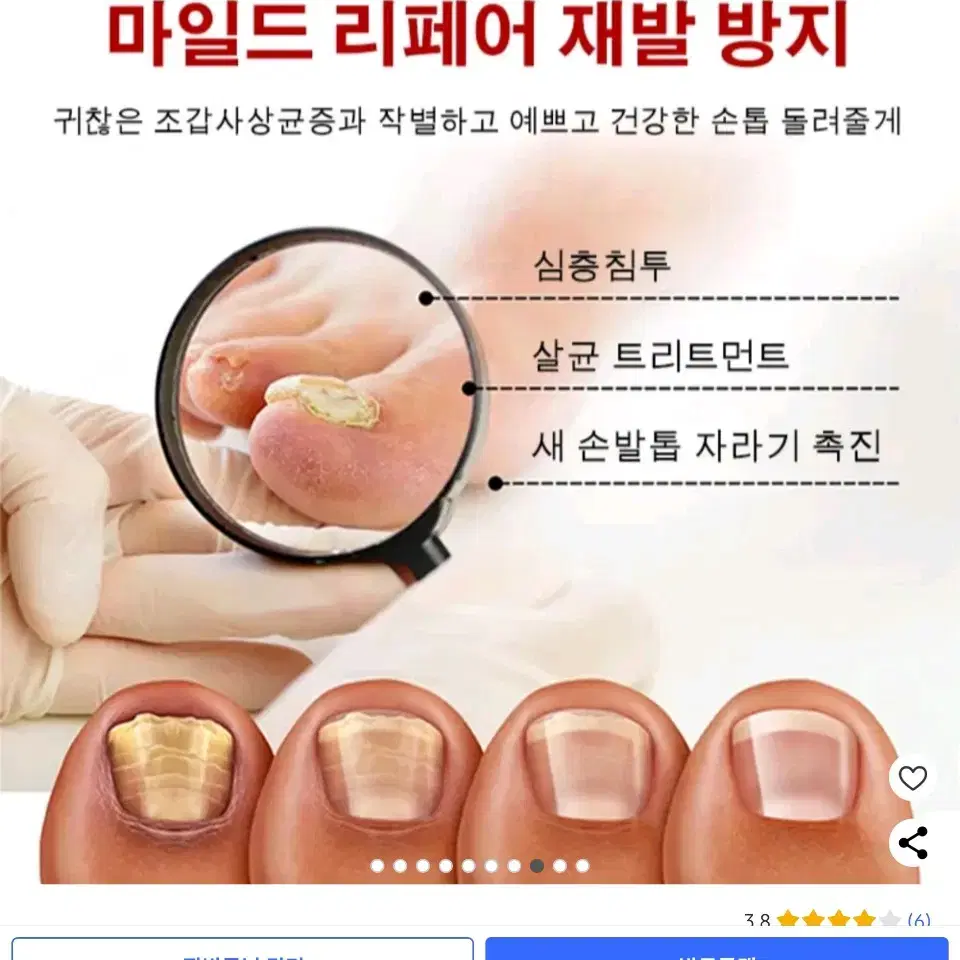 진균레이저, 발톱무좀