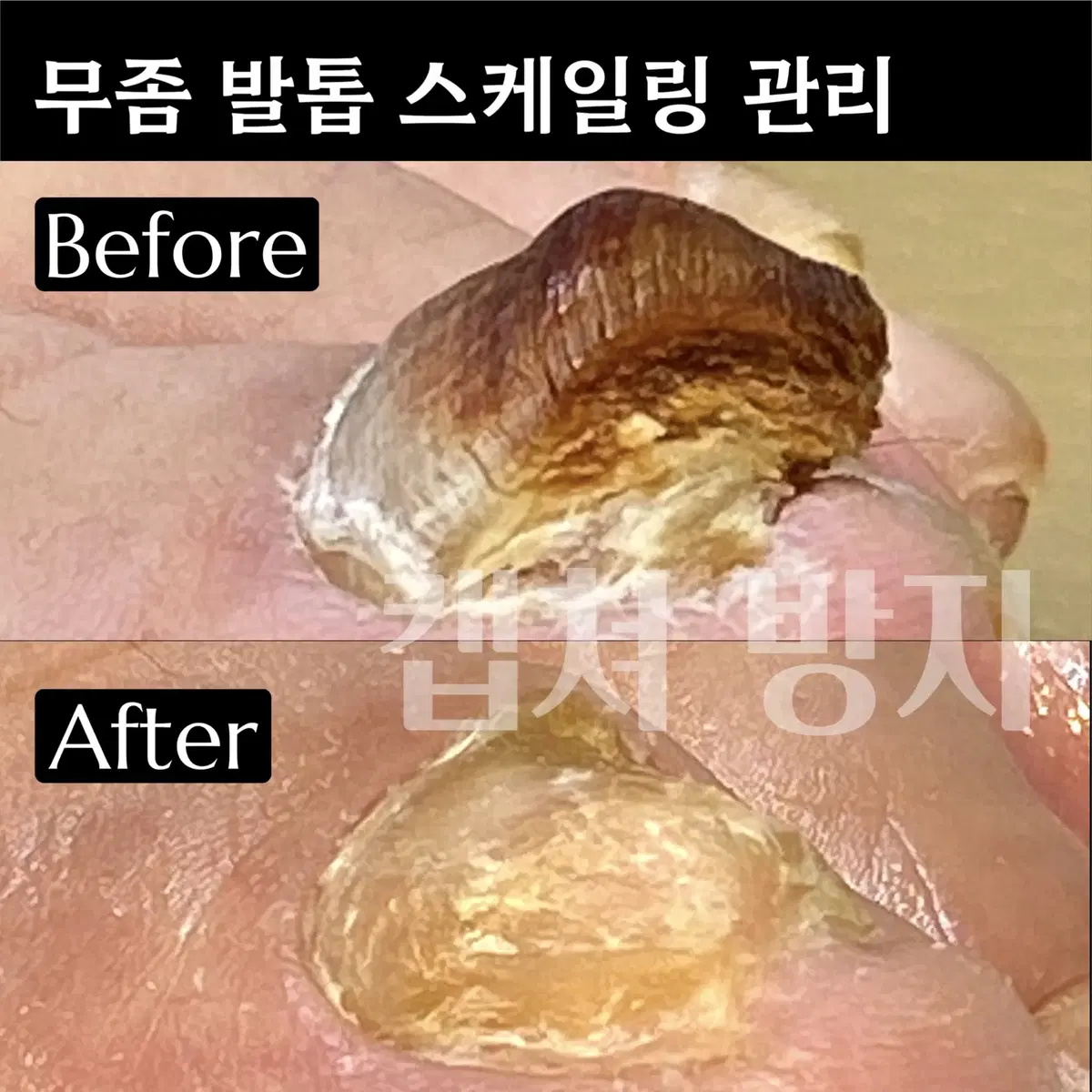 문제성 손발톱 체험(무좀/내성/발각질/물어뜯는손톱)