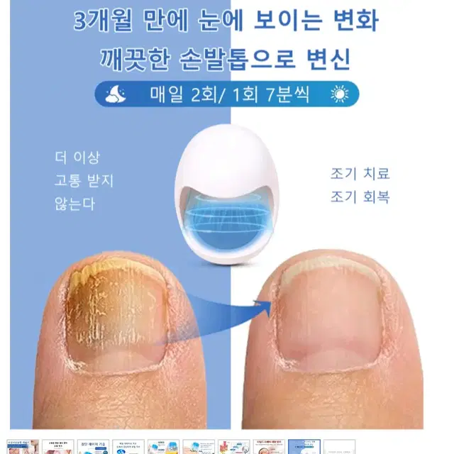 무좀치료, 진균레이저입니다