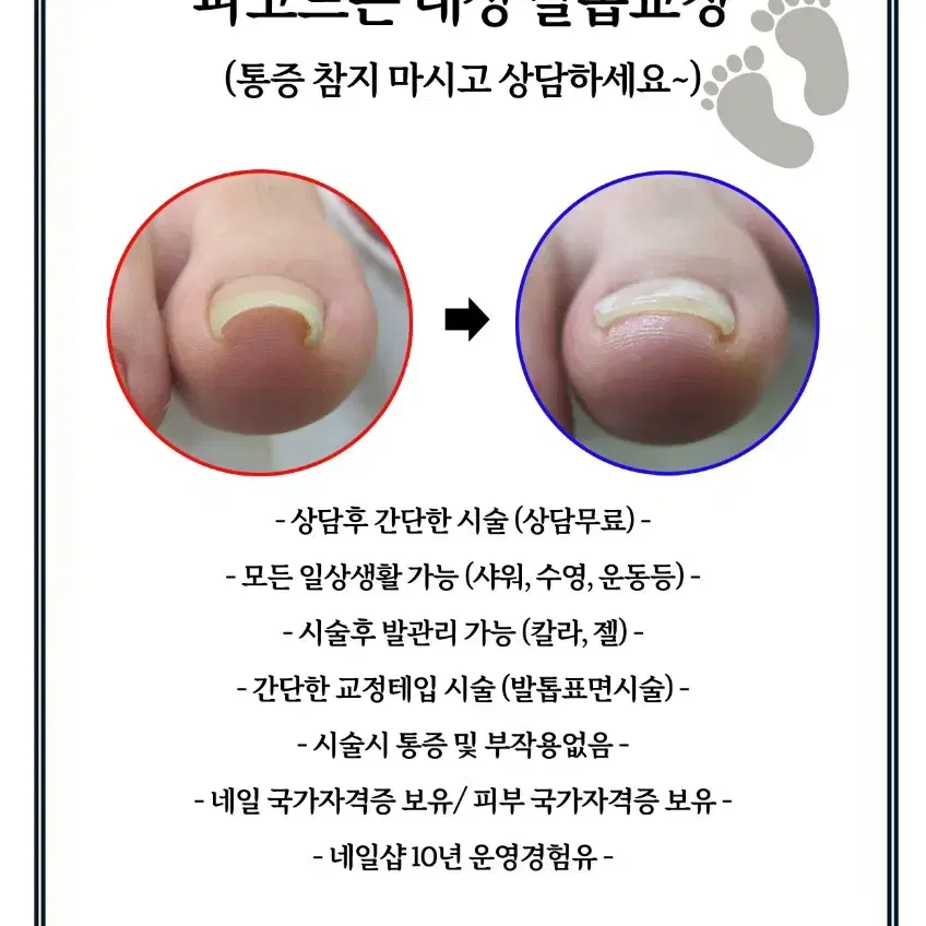 내성발톱교정