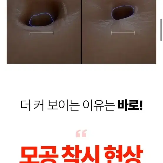 회전니들 MTS 크림 모공쪼임 모공크림