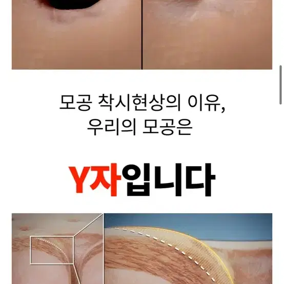 회전니들 MTS 크림 모공쪼임 모공크림