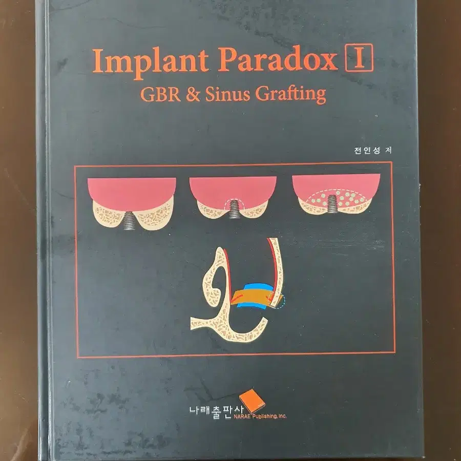 치과 임플란트 책 서적 implant paradox 부재 GBR&Graf