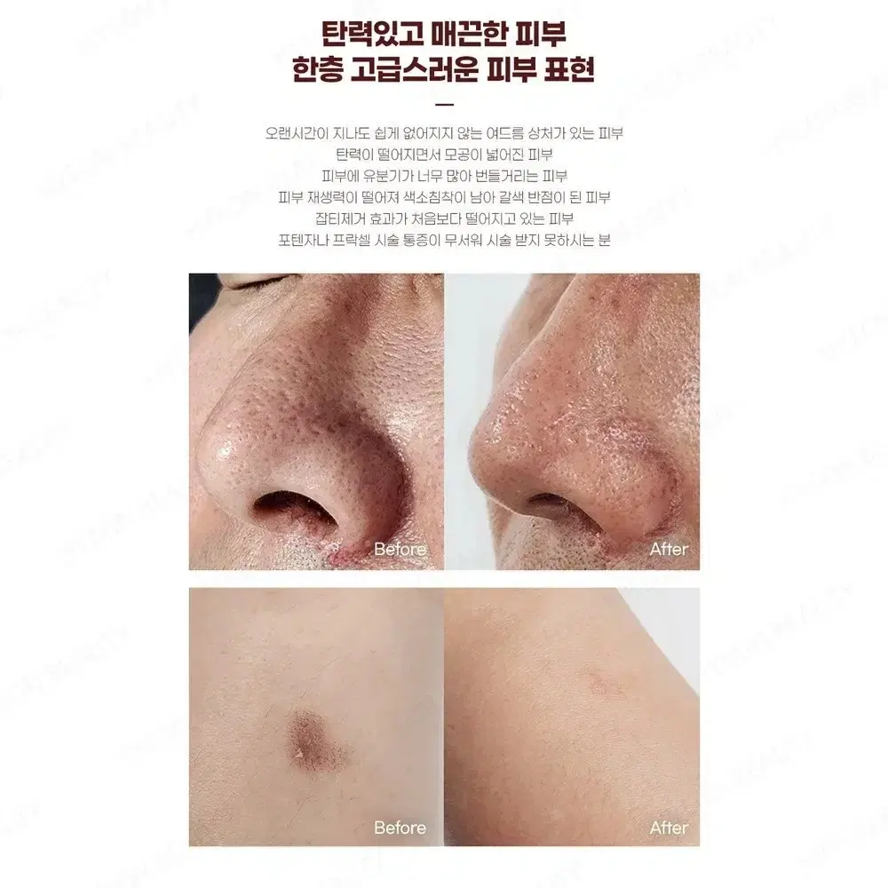 포텐 프락셔널 렌즈 레이저 전용 렌즈 레이져 렌즈 피부관리 렌즈