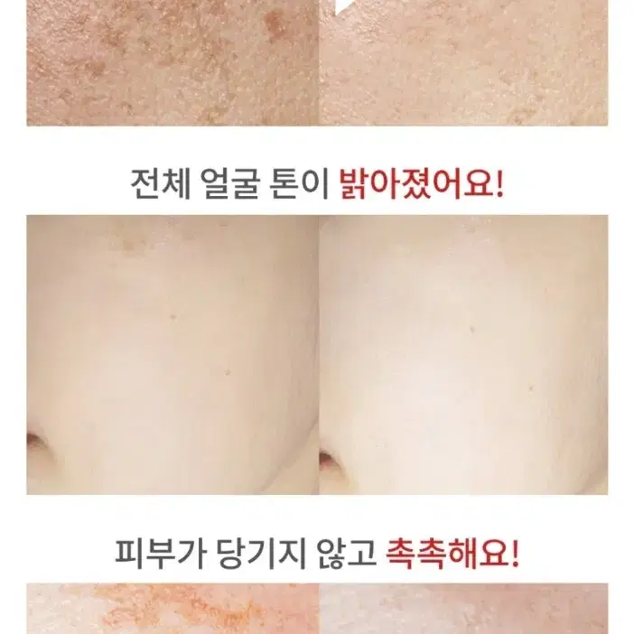 100%효과보장 토닝 레이저 필요X , 기미 주근깨 잡티 미백 기미 크림