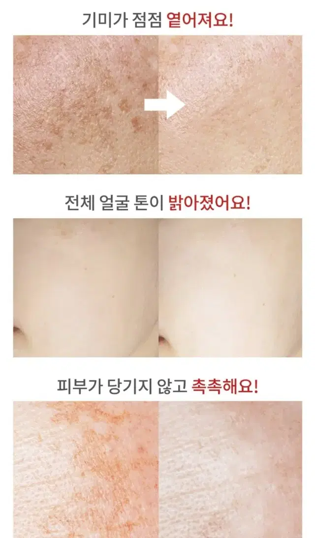 100%효과보장 토닝 레이저 필요X , 기미 주근깨 잡티 미백 기미 크림