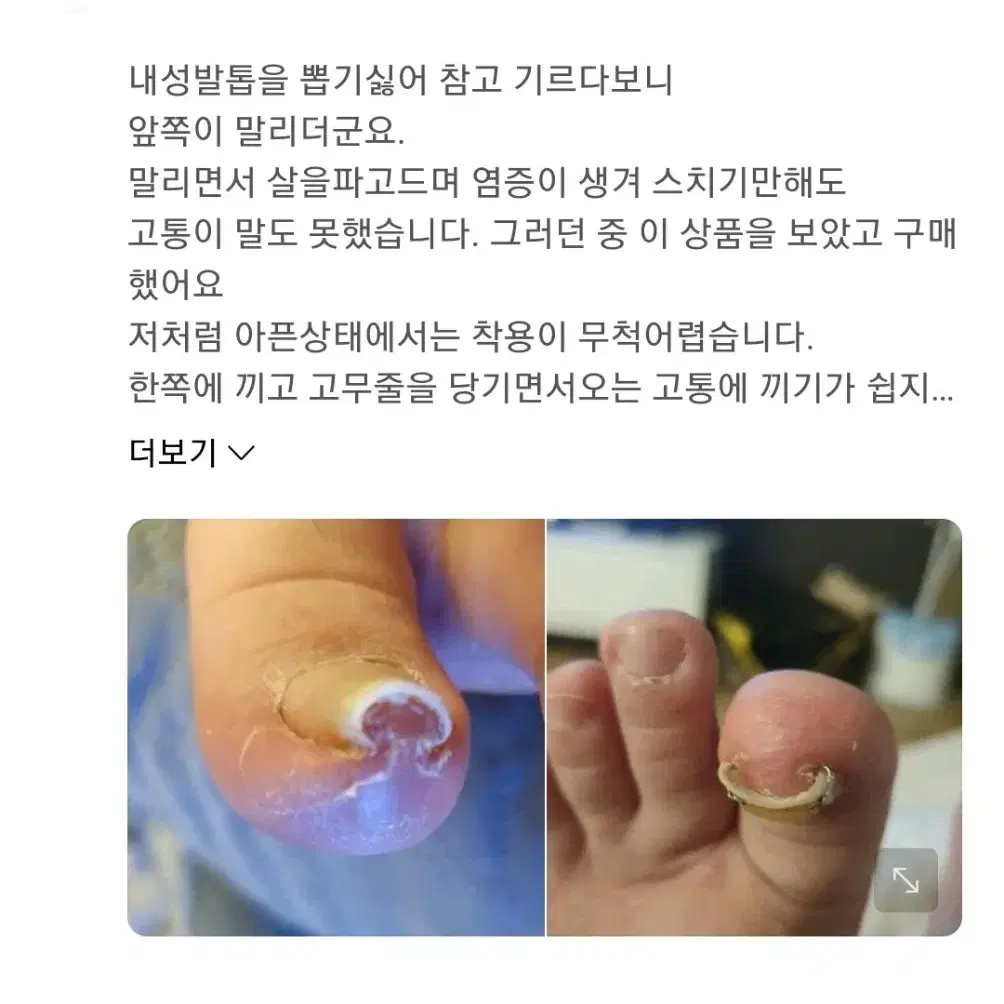 내성발톱교정기 새제품