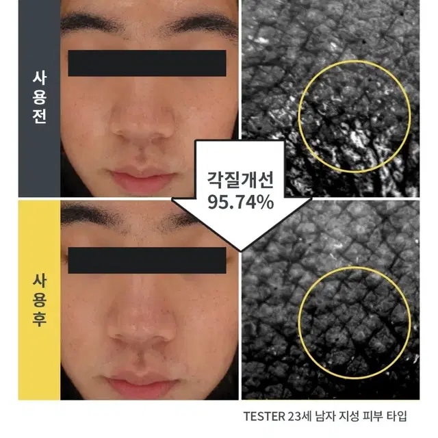 kg당6억의특허원료 진짜 여드름 기능성 클렌징 버블 아크네 클렌징폼