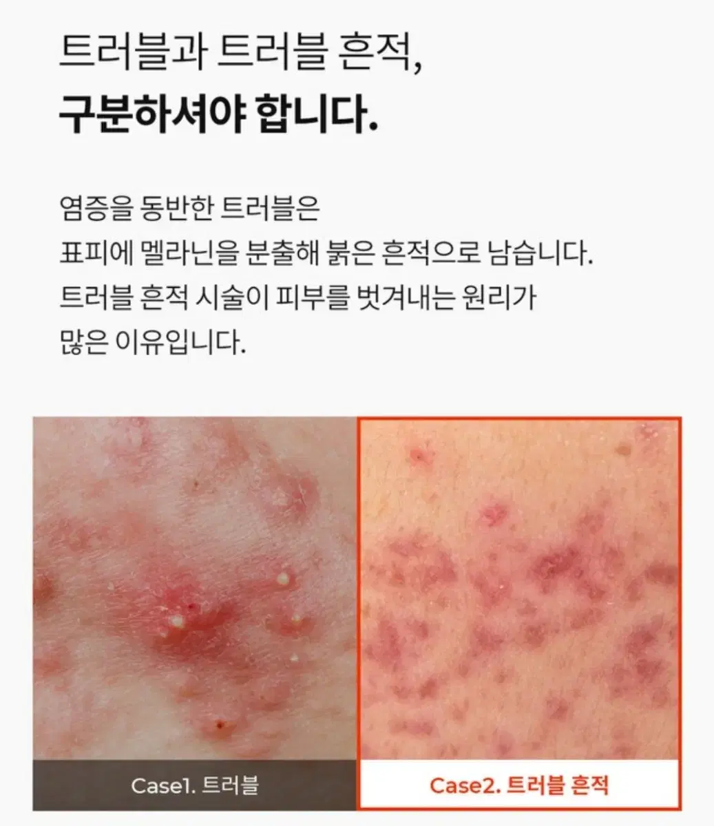 찐후기) 피부타입별 고민별 여드름 기미 주근깨 홍조 맞춤형 홈케어 추천