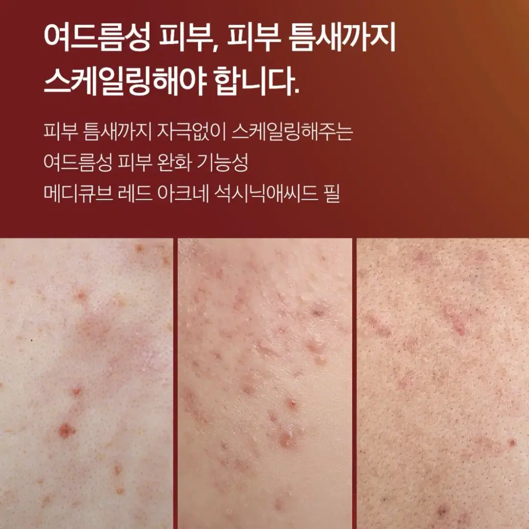 메디큐브 레드 아크네 석시닉애씨드 필