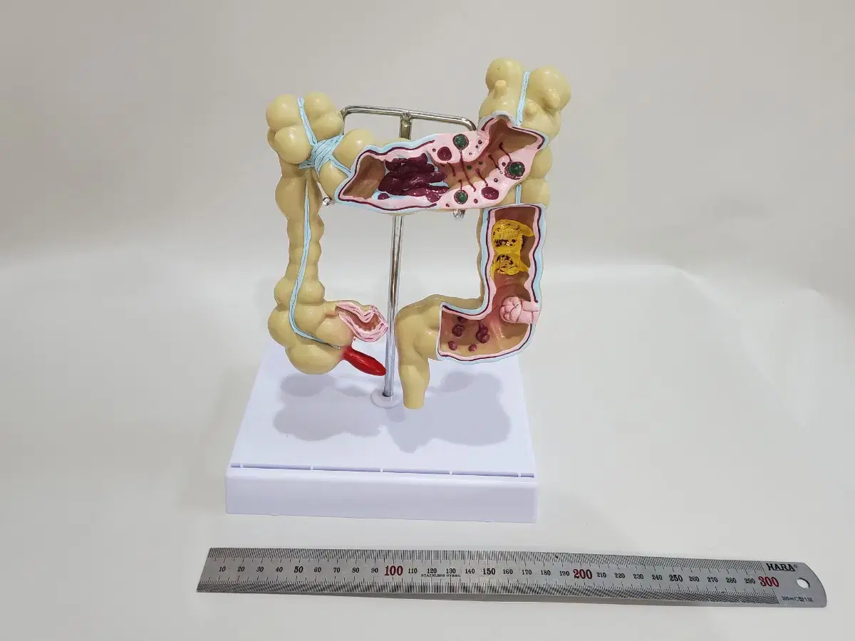 인체모형중  결장 병변모형 새제품 특가 판매합니다