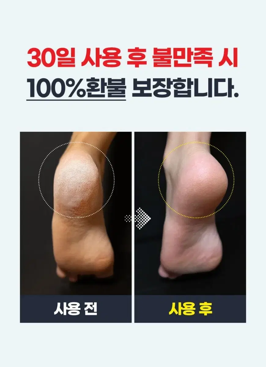 발각질 제거기 굳은살 제거