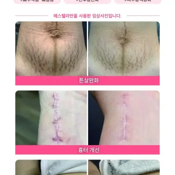 에스텔라 초음파물방울리프팅기계   피부관리기