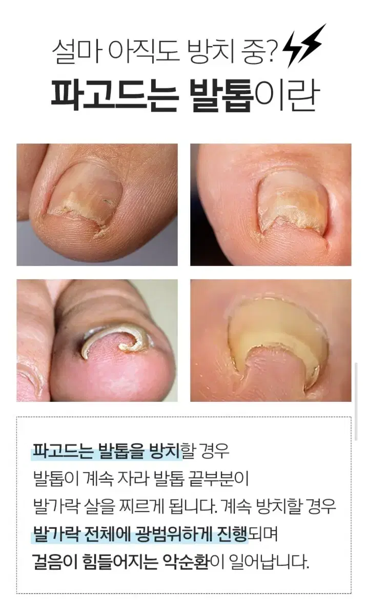 내성발톱 핀처밴드 PT-v3밴드 발톱교정기