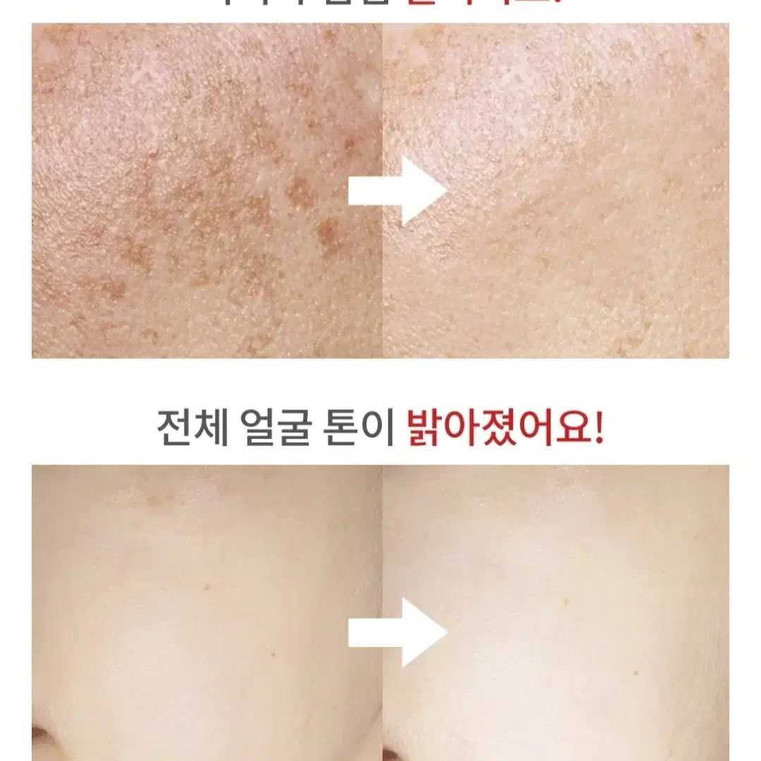 효과100% 토닝레이저 필요X ,기미 주근깨 잡티 미백 모공 피테라 크림