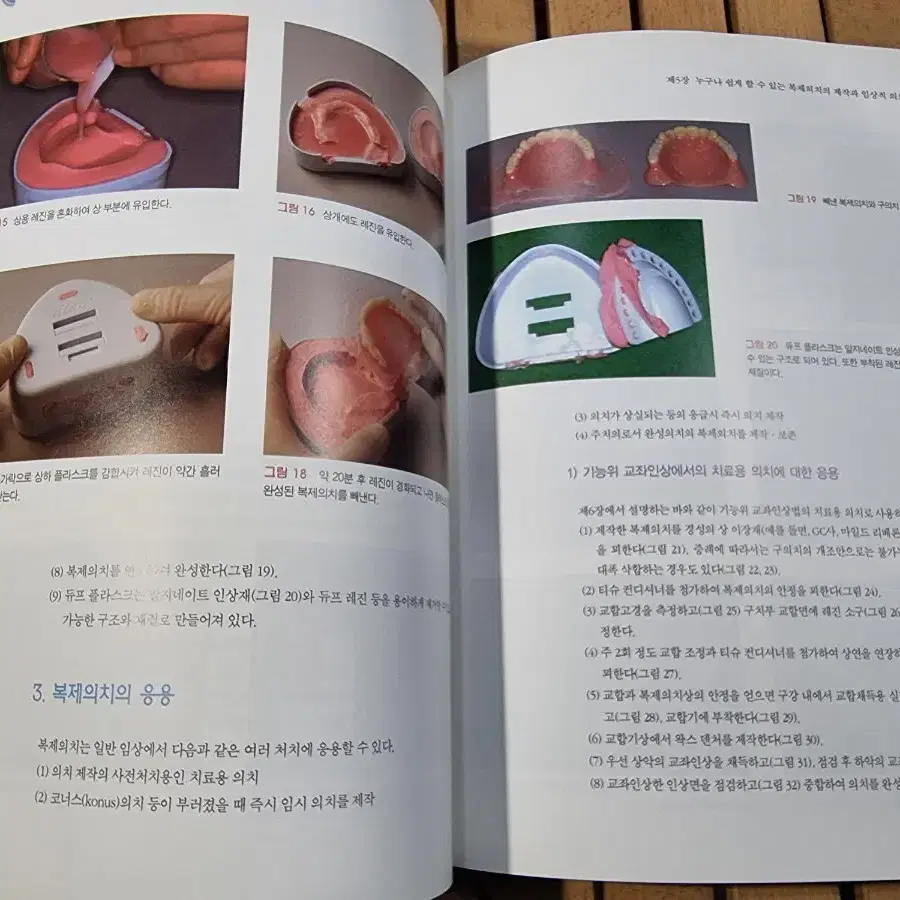 복제의치를 응용한 교좌인상법에 의한 총의치 임상