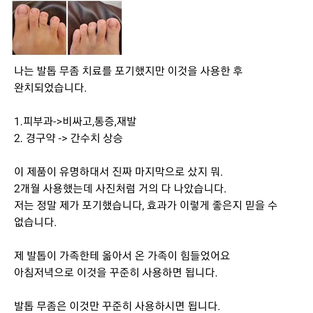 무좀