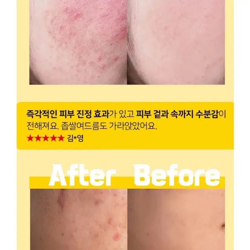 기미잡티제거크림 2개 트러블크림 안면홍조 진정크림 여드름피부 미백특허성분