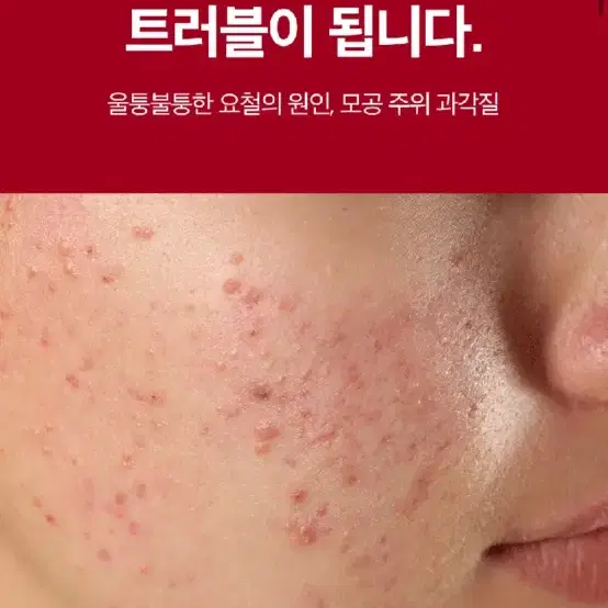 (새상품) 퓨리피아 이레이져 플러스 클린 젤 30ml 여드름 흉터 크림