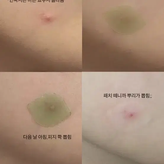 에셀라이트 여드름패치 스팟패치 진정패드 필오프팩 짱민주 공구