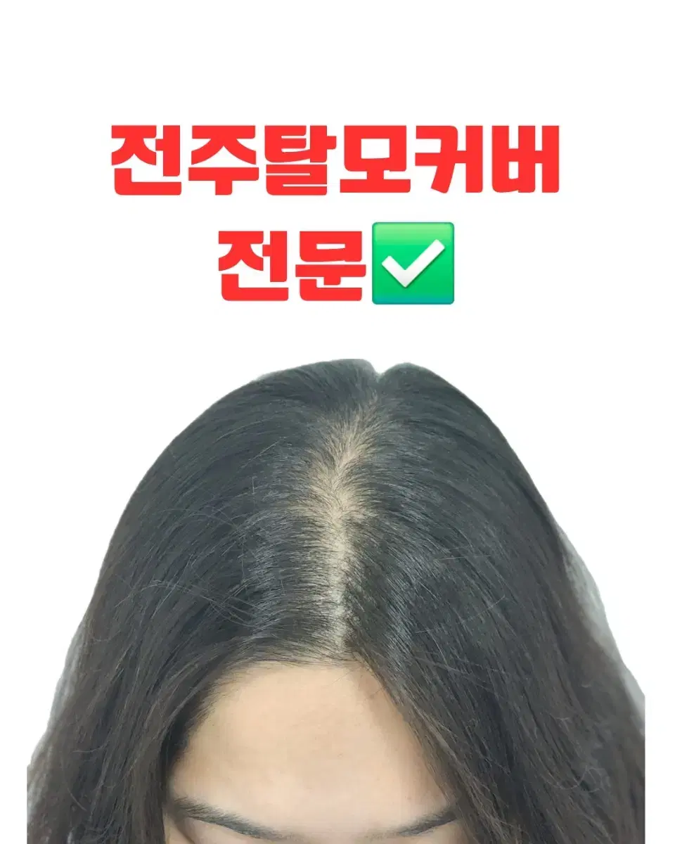 SMP hair loss cover (crown, part, hairline) exy