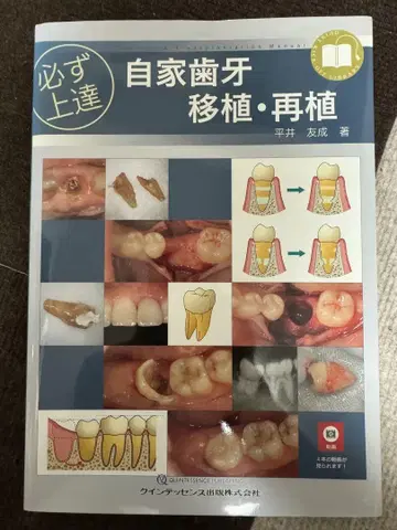 반드시 향상됩니다 자가 치아 이식 및 재식
