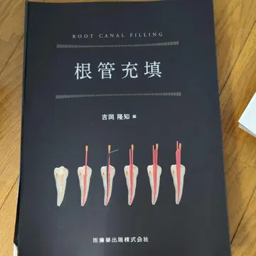 근관 충전 (절단 완료)