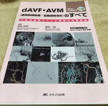 dAVF AVM(경막동정맥루 뇌동정맥기형)의 모든 것