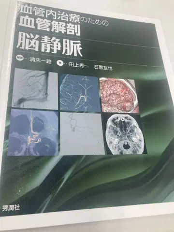 혈관 내 치료를 위한 혈관 해부 뇌정맥