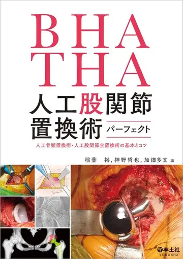 BHA THA 인공 고관절 치환술 퍼펙트 (재단됨)