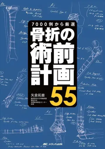 골절의 수술 전 계획 55 절단됨