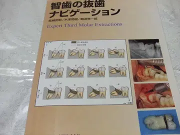 사랑니 발치 내비게이션